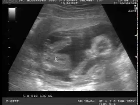 Video del cuarto ultrasonido ¡Es Niño! - YouTube