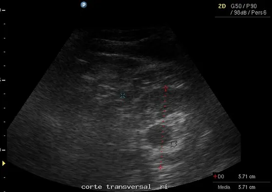 Fotos de ecografia de 1 mes - Imagui