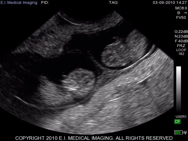 WTF? Un gemelo no nacido se convierte en el “padre” de su sobrino ... WTF? Un gemelo no nacido se convierte en el “padre” de su sobrino ...